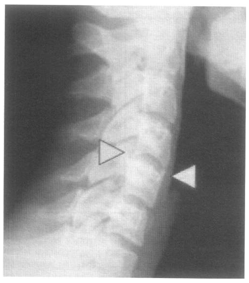 Формирующиеся задний и передний синдесмофиты в шейном отделе позвоночника у больного ЮАС.